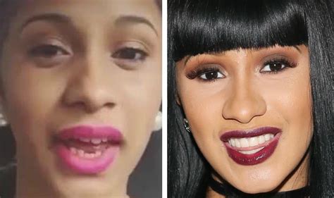 cardi b teeth before surgery